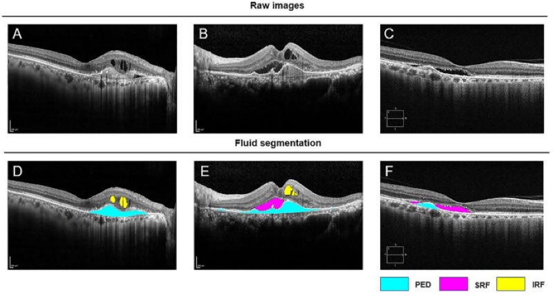 OCT biomarkers predicting treatment interval in neovascular AMD